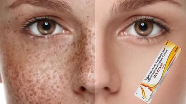 Melacare Skin Cream: The Hidden Miracle for Perfect Skin