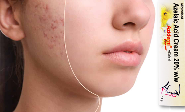 Aziderm 20 Gel: Your Secret to Clear, Glowing Skin!