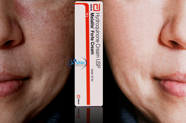 Hydroquinone Cream for Flawless Skin: Your Key to a Stunning Complexion!