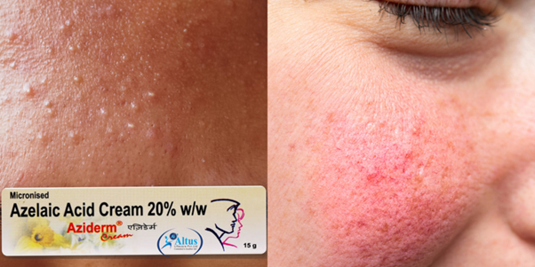 Aziderm 20 Cream: The Ultimate Solution for Beautiful Skin!
