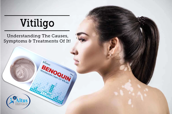 Benoquin Cream 20%: The Breakthrough Solution for Vitiligo You Need!