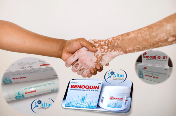 Discover the Miracle Benoquin 20% Cream: Monobenzone for Vitiligo Transformation!
