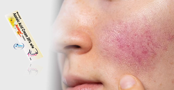 Aziderm 20 Gel: Your Secret to Clear, Glowing Skin!